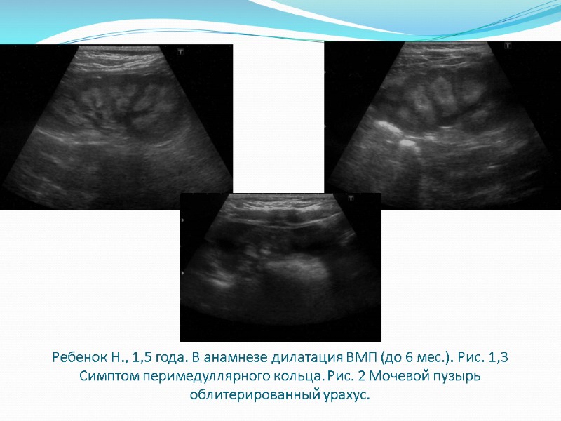 Ребенок Н., 1,5 года. В анамнезе дилатация ВМП (до 6 мес.). Рис. 1,3 Симптом
